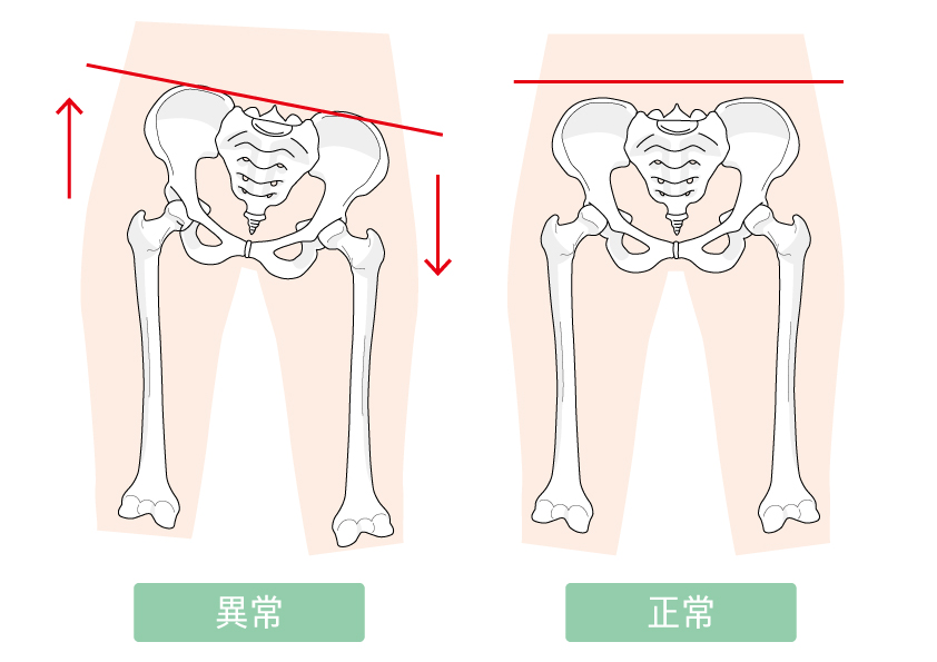 骨盤の正常な状態と歪んだ状態の図