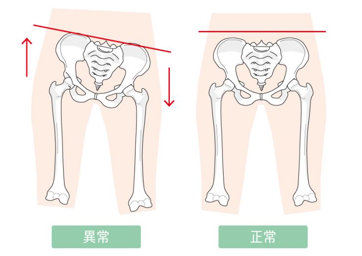 骨盤の正常な状態と歪んだ状態の図